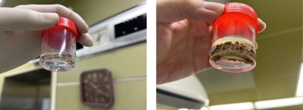 炎炎夏日 小心泌尿結石來敲門