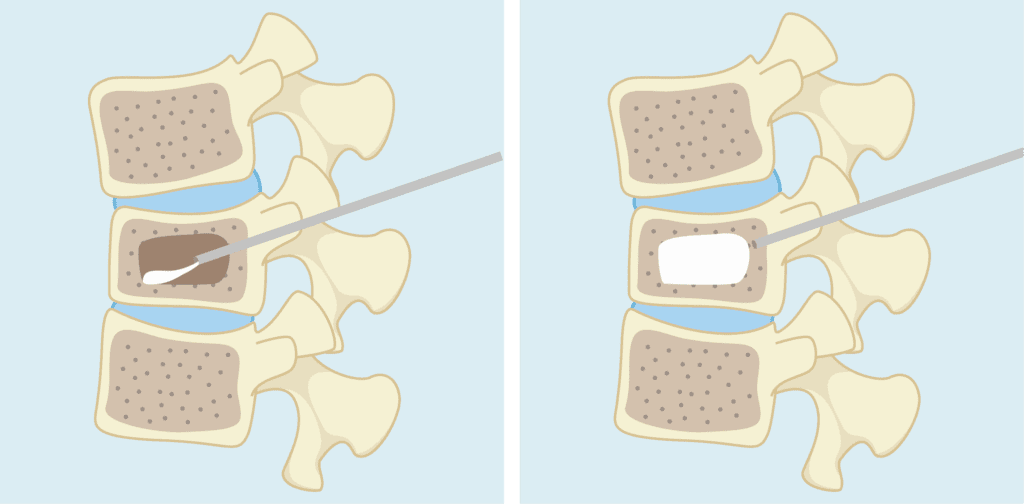背痛別輕忽-　當心骨質疏鬆正在掏空你的骨骼