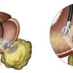 北市聯醫完成首例eus引流術　成功治療壞死性胰臟炎併發症