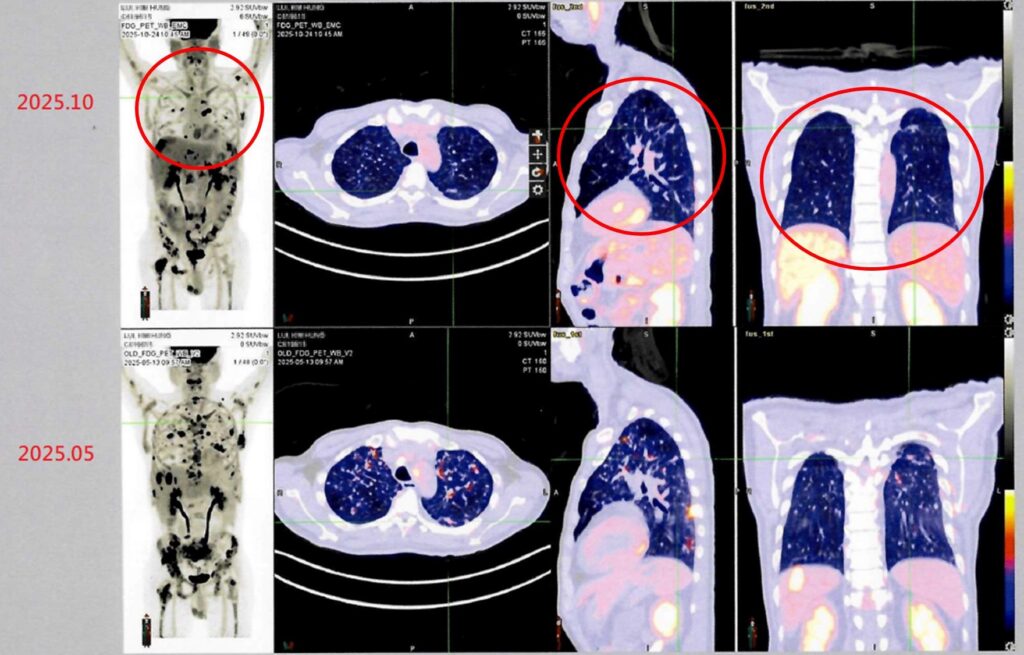 台灣細胞治療技術展現新希望　跨國癌症患者肯定臨床成果