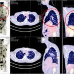 台灣細胞治療技術展現新希望　跨國癌症患者肯定臨床成果