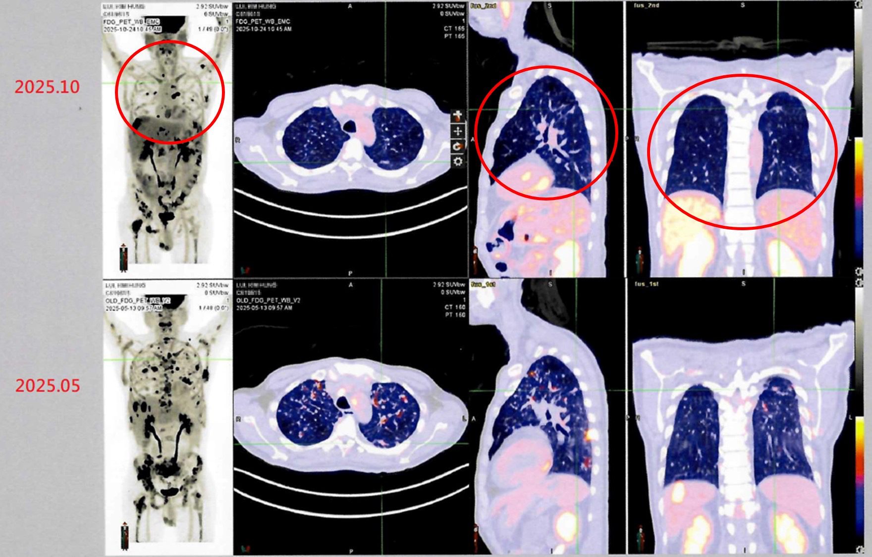 台灣細胞治療技術展現新希望　跨國癌症患者肯定臨床成果